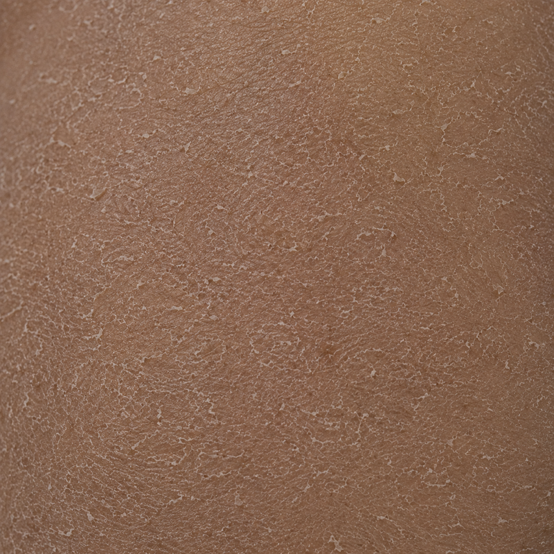 Dry Skin