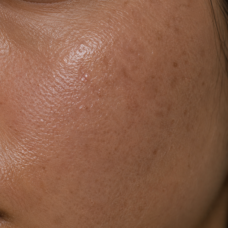 Oily Skin